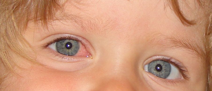 A child’s eye showing redness and irritation.